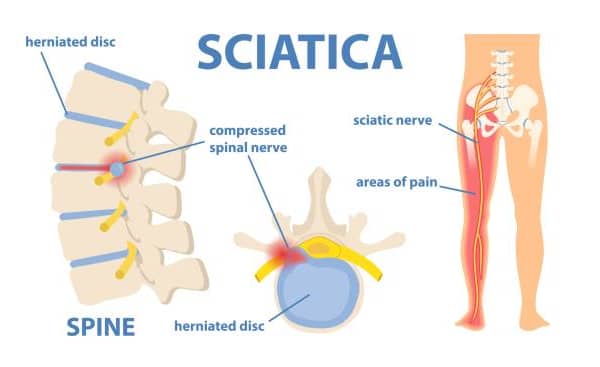 Symptoms and Treatment for Sciatica